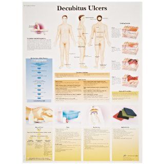 3B Scientific VR1717UU Glossy Paper Decubitus Ulcers Anatomical Chart, Poster Size 20" Width x 26" Height: Industrial & Scientific