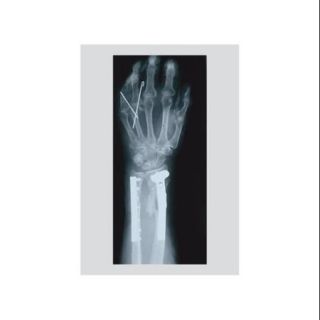Arm & Finger X rayPrint (Unframed Paper Poster Giclee 20x29)